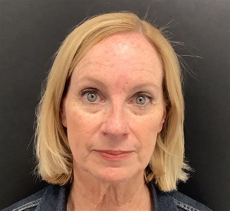 Eyelid Surgery and Facelift