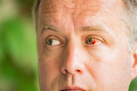 subconjunctival hemorrhage broken blood vessel   eye