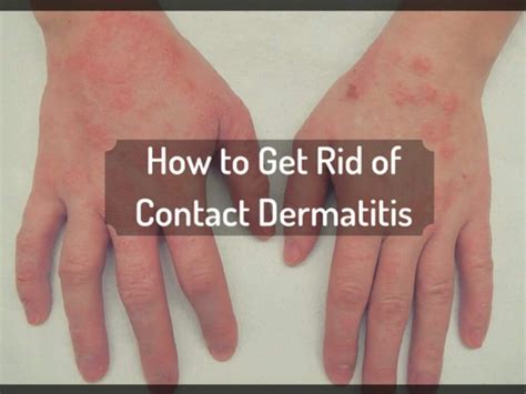 contact dermatitis   treat  prevent  lifestyle uganda