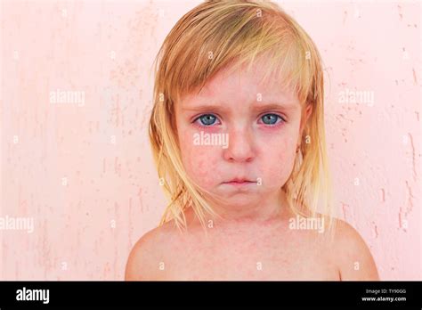 roseola face viral rash roseola   similar experiences