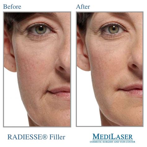 RADIESSE® Before and After - Medilaser Surgery and Vein Center