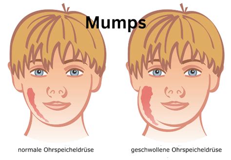 Mumps Disease: Sign, Symptoms, Treatment and Complication