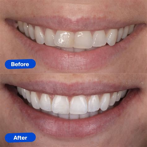 What Smile Aligners Reviews Really Mean For Your Dental Health