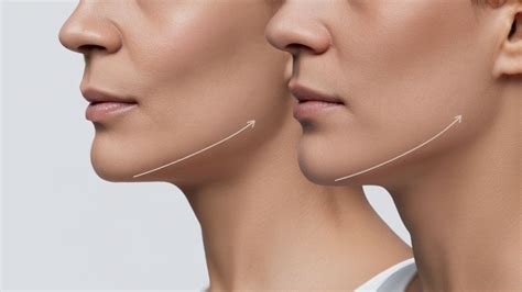 jawline implant    process max face implant
