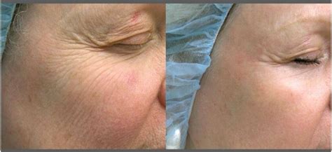 Erbium Skin Resurfacing - Lasertouch MD