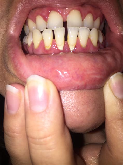 Have I ruined my teeth? : Dentistry