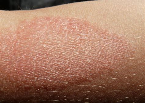 eczema   describe eczema    symptoms  types