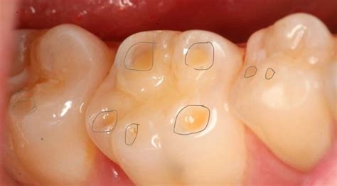 understanding tooth erosion   solutions