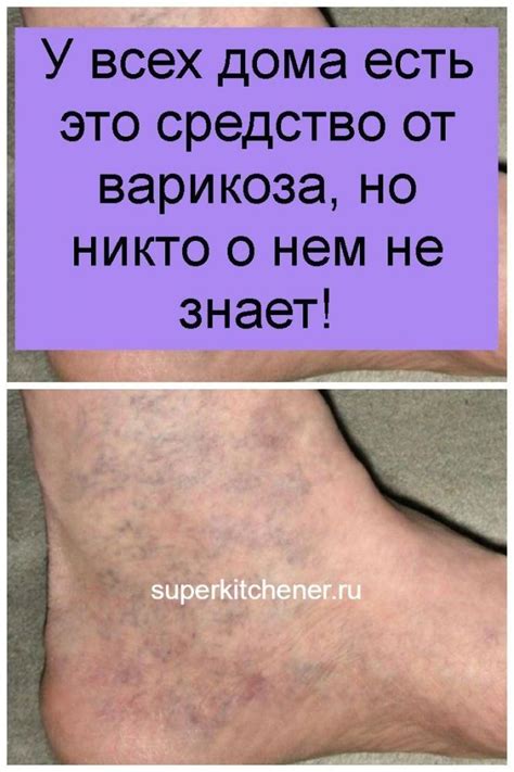 У всех дома есть это средство от варикоза но никто о нем не знает в ...