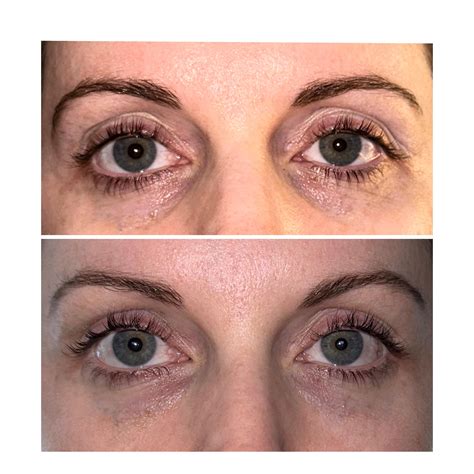 Can anyone tell a difference in my tear troughs? I had very severe tear