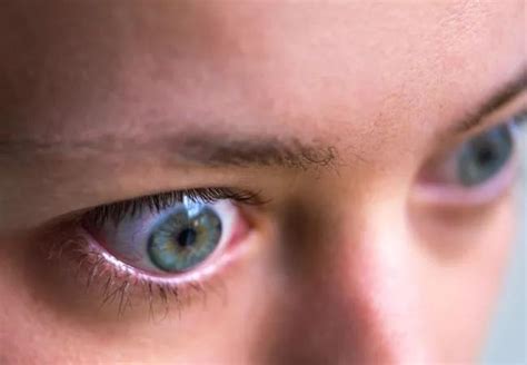 managing thyroid eye disease