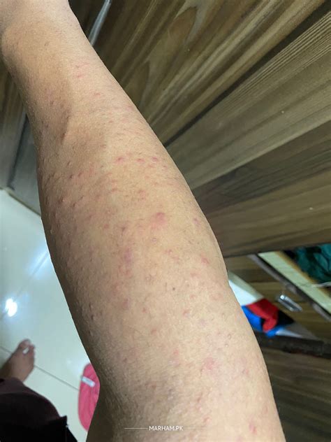 Ask a Dermatologist Online for Skin Allergy - Dermatitis