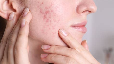 chec nhs acne treatment