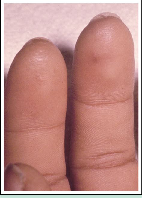 oslers nodes  janeway lesions semantic scholar