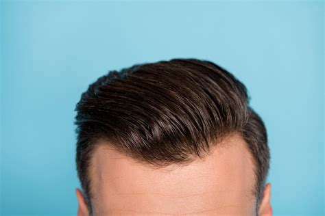 people notice  hair transplant expert insights tips
