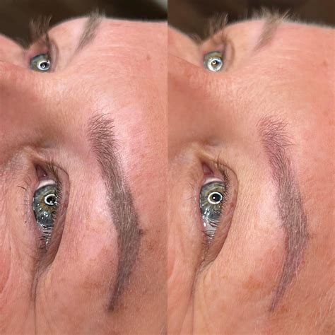 saline removal tattoo