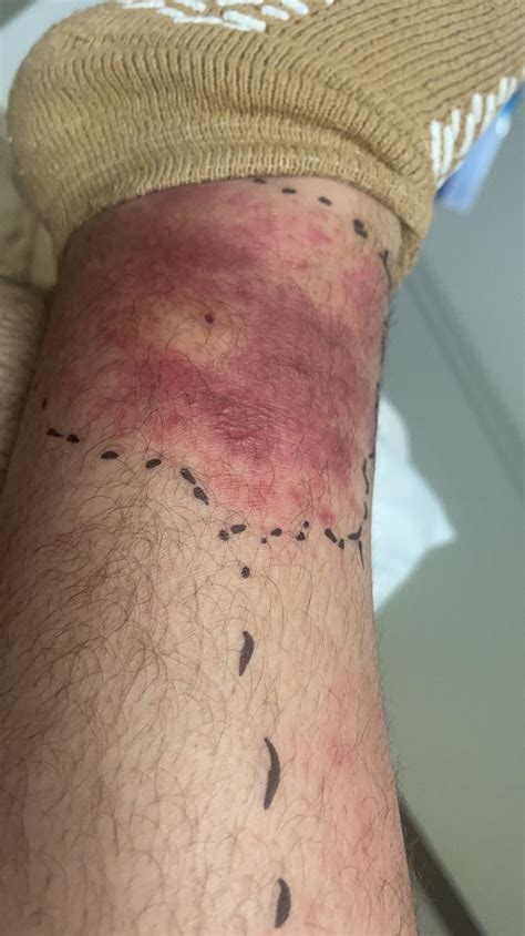Brown recluse spider bite: What to know after Atlanta man almost lost