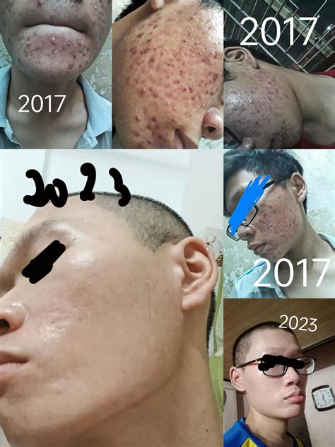 Severe Acne