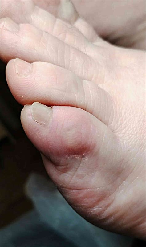 Why you should check for ‘Irish pinky toe’ – and what to do if you have one