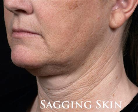 Sagging Skin - Coastal Valley Dermatology