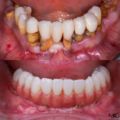 Tratamiento de enfermedad periodontal en arcada inferior