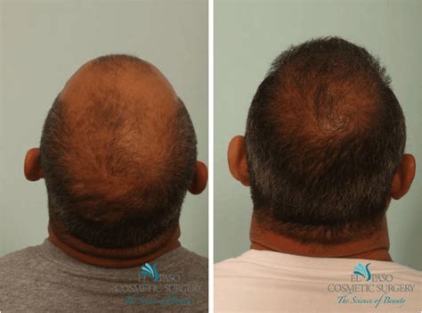 How Much Does PRP Hair Restoration Cost? - El Paso Cosmetic Surgery