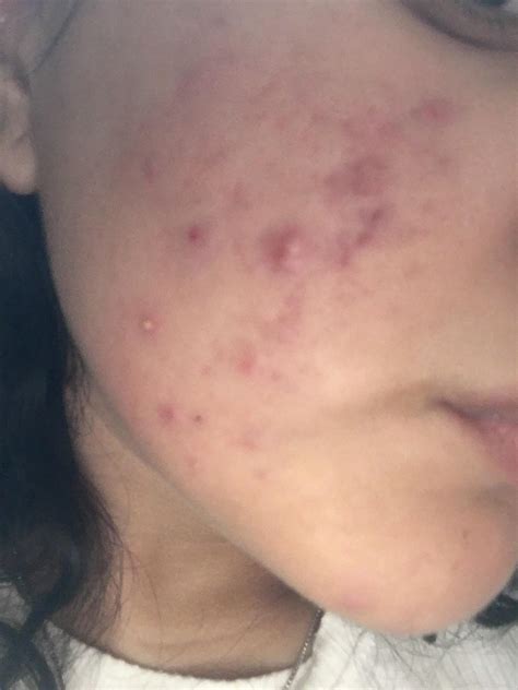 Cystic Acne
