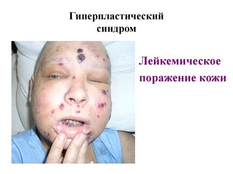Симптоматология острых и хронических лейкозов - презентация онлайн