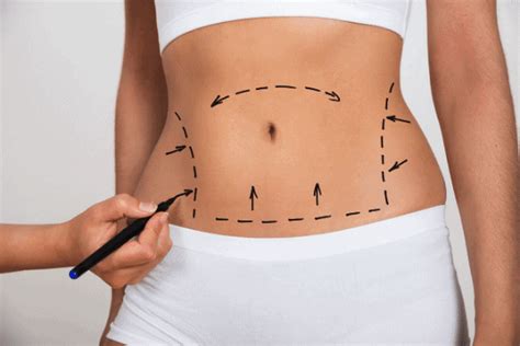 plastic surgery finance   bad credit western