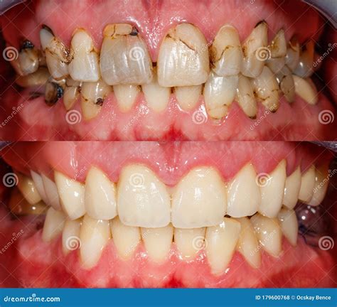 Dentes Antes E Depois - Dentes Antes E Depois Do Tratamento Foto de Stock - Imagem de médico ...