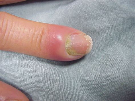 nail fold infections paronychia acquired periungual