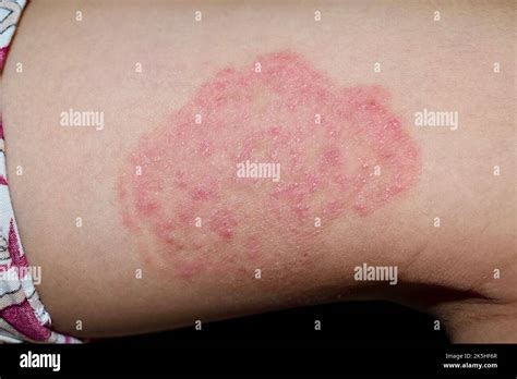 fungal infection called tinea corporis  thigh  southeast asian