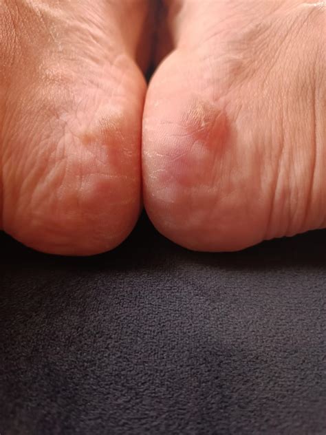 Asics Kayano 30 Heel Blister Issue during Running - Xolvie