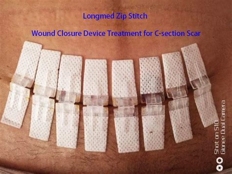 how to know if c section scar is infected