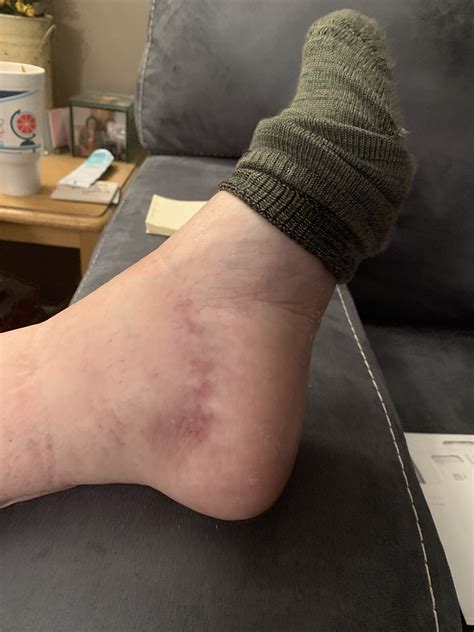 How to quickly heal a sprained ankle – Artofit