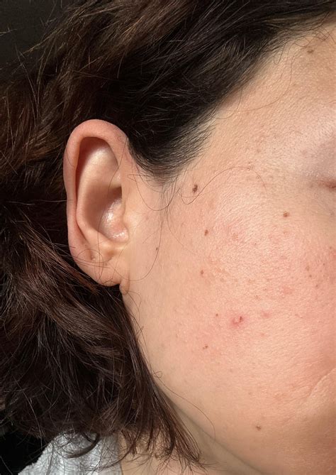 [Acne] can you help me clear my skin off this brown and small bumps