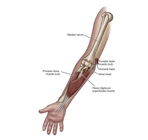 Pronator Teres Syndrome - MN Spine and Sport