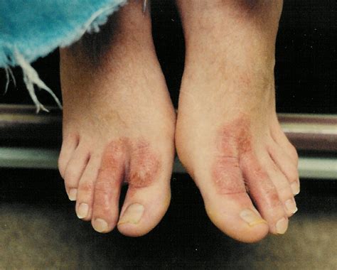 Dermatitis On Feet