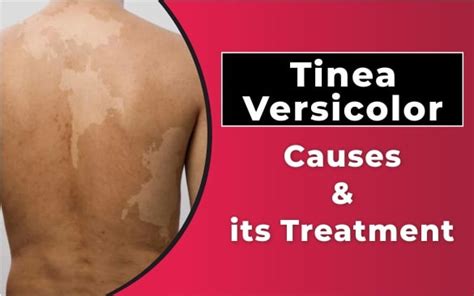 Tinea Versicolor Neck