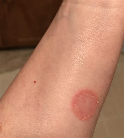 What Viral Rash Looks Like Ringworm at Keith Turner blog