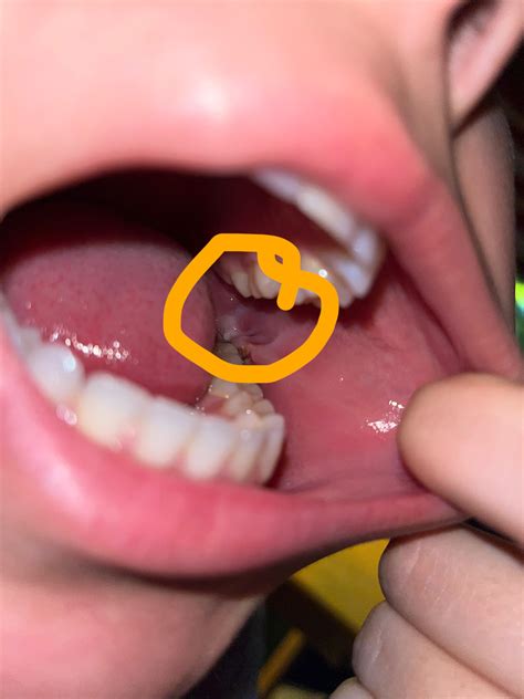 Wisdom teeth recovery : r/Teethcare