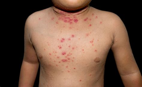 molluscum contagiosum treatment  kids  adults  omaha nebraska