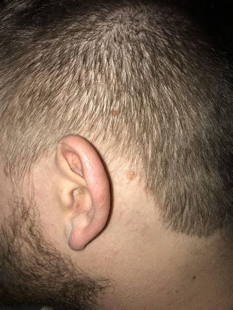 Just noticed spots on scalp : r/DiagnoseMe