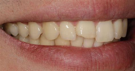 chipped single front tooth  ceramic rogers ar