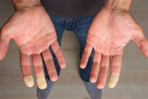 Raynaud's phenomenon causes small arteries to contract | UCLA Health