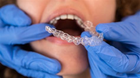 Do Dental Insurance Plans Cover Clear Aligners and Invisible Braces