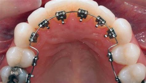 lingual braces incognito braces inbrace