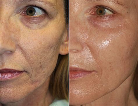 Micro Needling: Microneedling Dangers – TDYARW