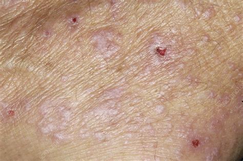 Lichen Planus Skin Rash