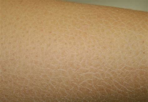 Xerosis - Definition, Pictures, Treatment, Symptoms and Causes - HubPages